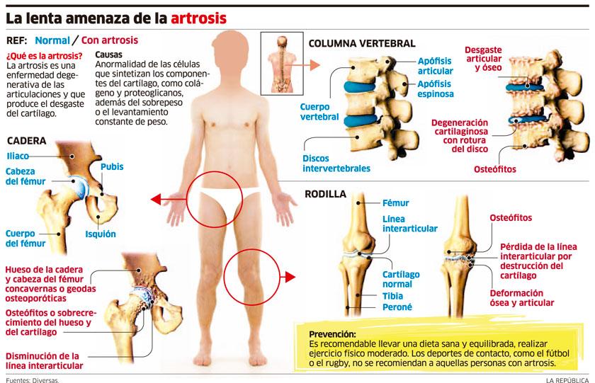 La artrosis te puede dejar sin caminar